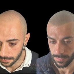 Barbagallo Tricopigmentazione