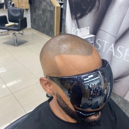 Nir Zoari | Hair Simulation Clinic for Men
